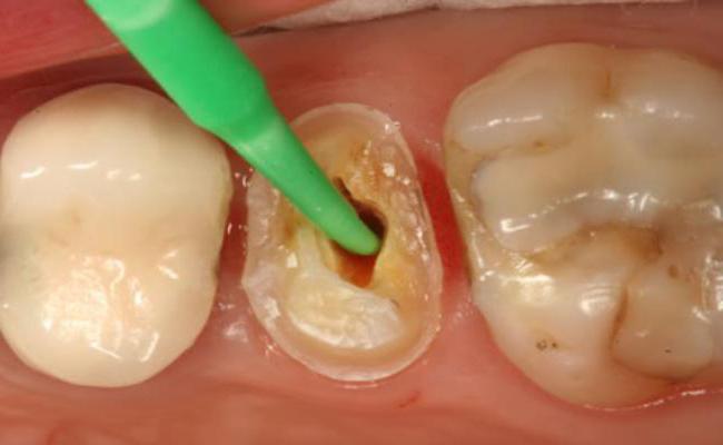 치아 근관 충전